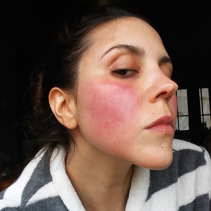 Managing Persistent Rosacea Redness: Daily Strategies That Actually Work 2 image 1