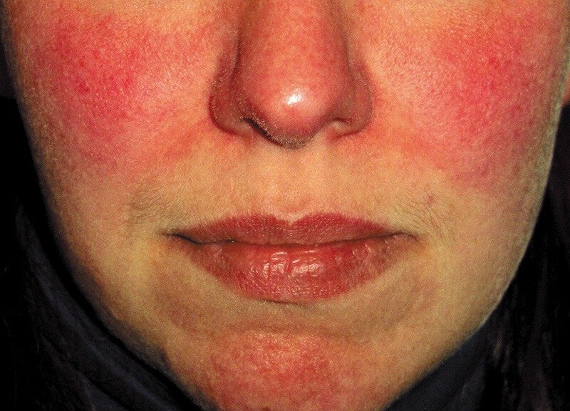 Managing Persistent Rosacea Redness: Daily Strategies That Actually Work 3 image 2